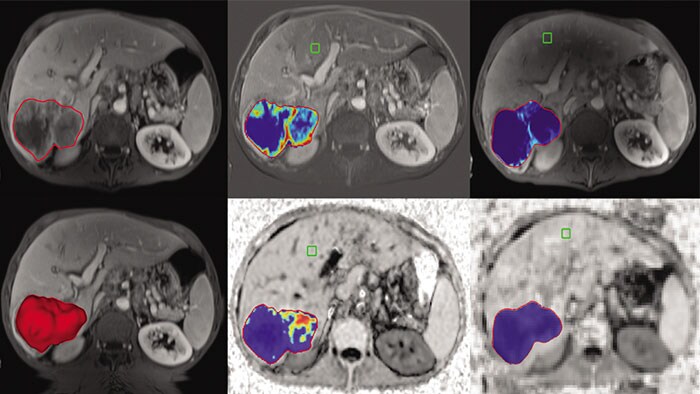 tumor tracking qeasl thumbnail