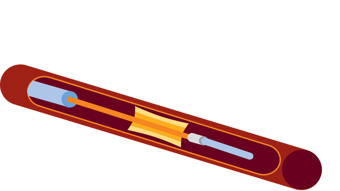 Pd Pa vessels