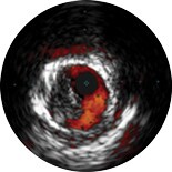 Thrombus image