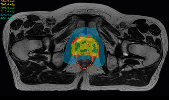 Delineation and dose planning