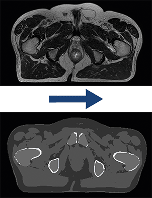 Delineation and dose planning