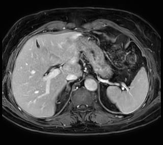 MCVI Ambition abdominal MRI