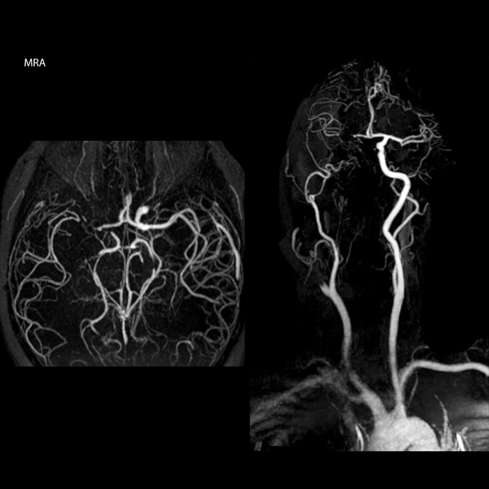 Acute ischemic stroke mra scan side view
