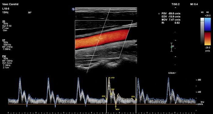 EPIQ L18-5 Vascular MaxVue