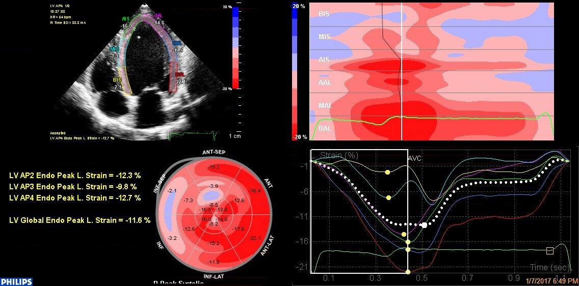 Philips automated cardiac motion quantification four-up display