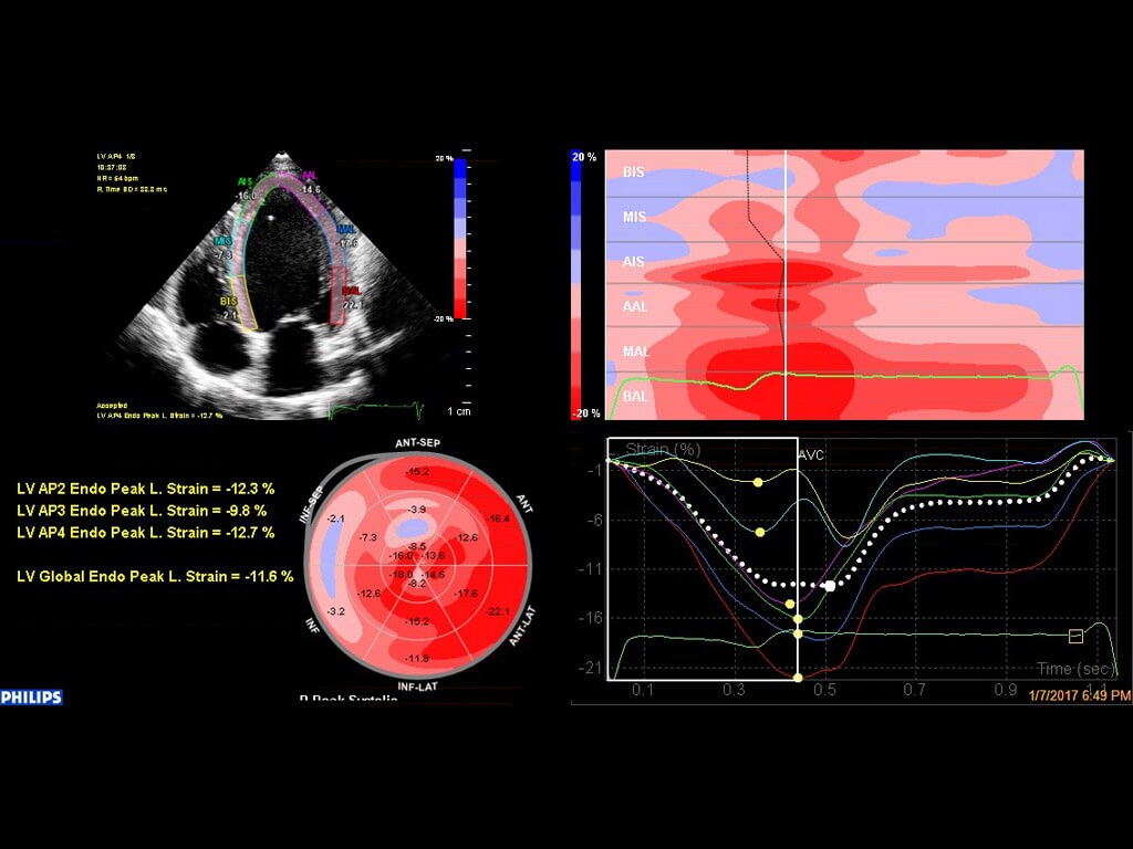 Philips automated cardiac motion quantification four-up display