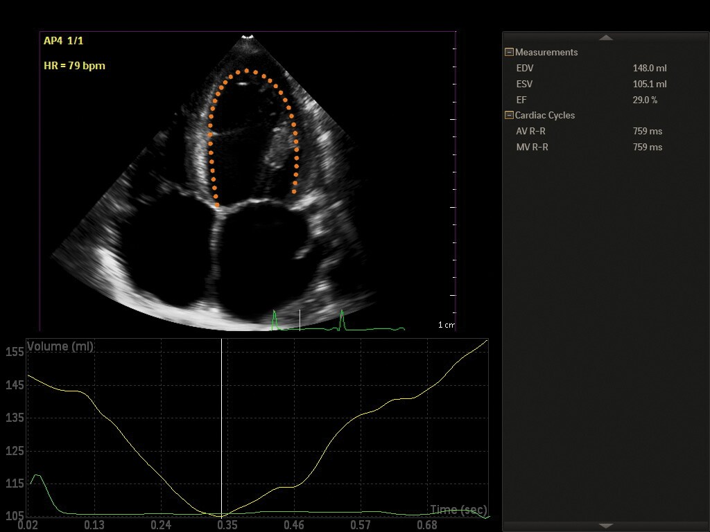 Philips automated 2D cardiac motion quantification