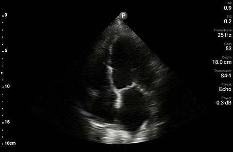 dyspnea patient left side