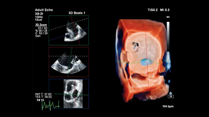 Philips cardiology TrueVue thumbnail