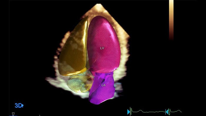 Dynamic HeartModel with A.I. thumbnail