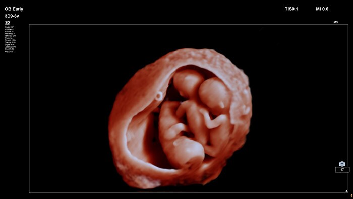 TrueVue - Advanced obstetric visualization tool thumbnail