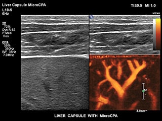 Liver Capsule MCPA