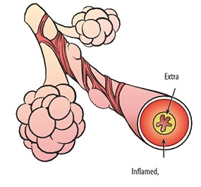 COPD Disease - Lungs with chronic bronchitis