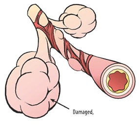 COPD Disease - Lungs with Emphysema