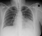 Chest X- ray