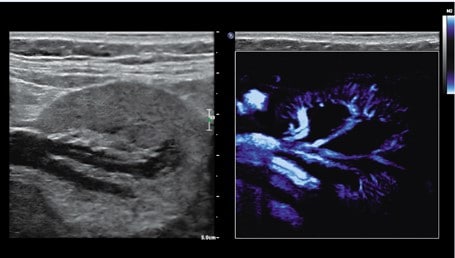 Affiniti ultrasound pediatric kidney